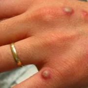 A case of monkeypox has been identified in Hertfordshire, the county council has said (File picture)